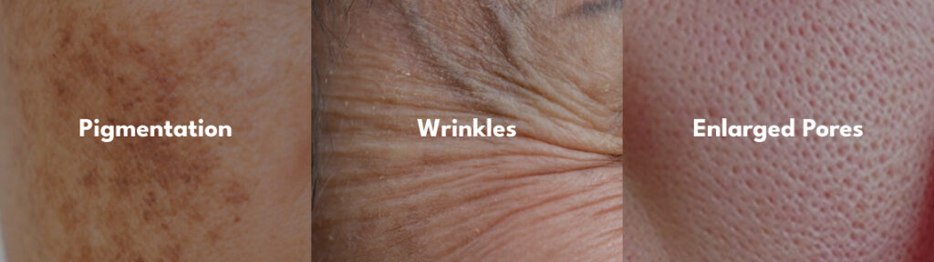 Pigmentation Wrinkles Enlarged Pores Treatment